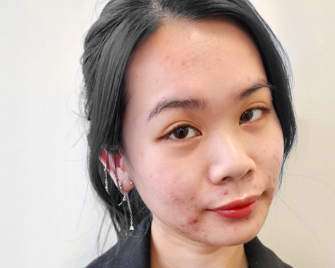 How I Finally Got My Adult-Acne Under Control