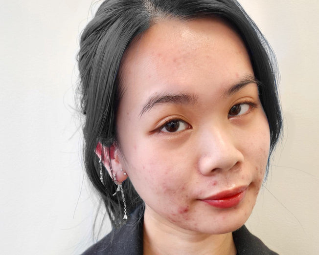 How I Finally Got My Adult-Acne Under Control