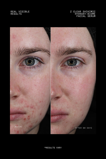 Z Clear Shikimic Hydroxy-Biome Facial Serum