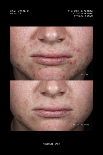 Z Clear Shikimic Hydroxy-Biome Facial Serum