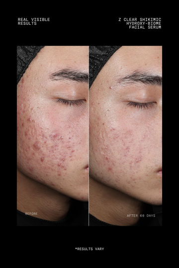 Z Clear Shikimic Hydroxy-Biome Facial Serum