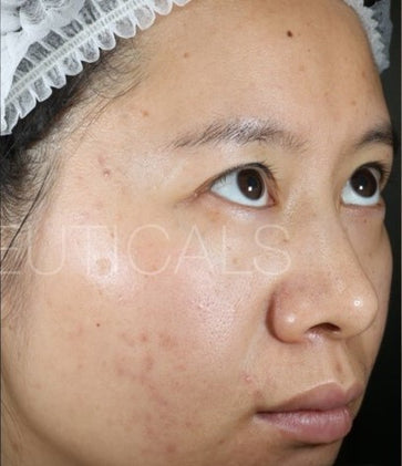 Ultra Clear Treatment Lotion Online – Ultraceuticals NZ